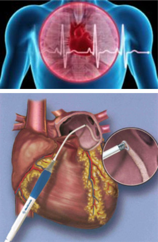 Chirurgie de la fibrillation auriculaire